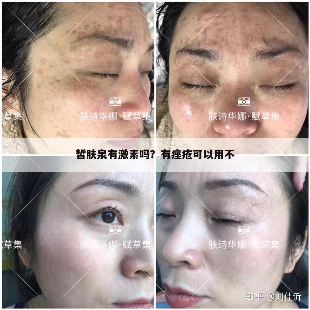 皙肤泉有激素吗?有痤疮可以用不